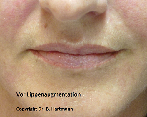 Vor Lippenaugmentation
