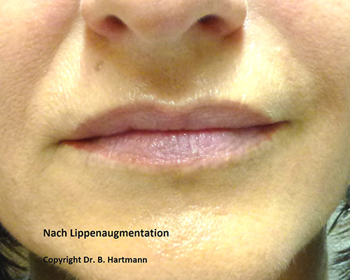 Nach Lippenaugmentation