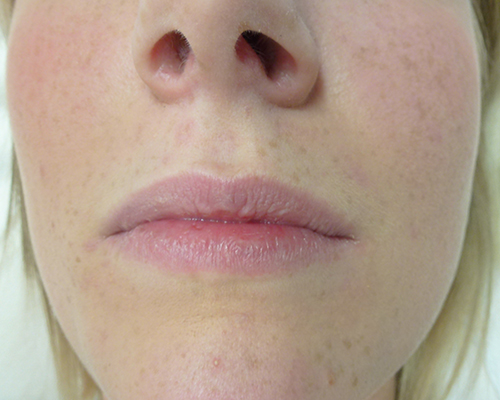 Vor Lippenaugmentation