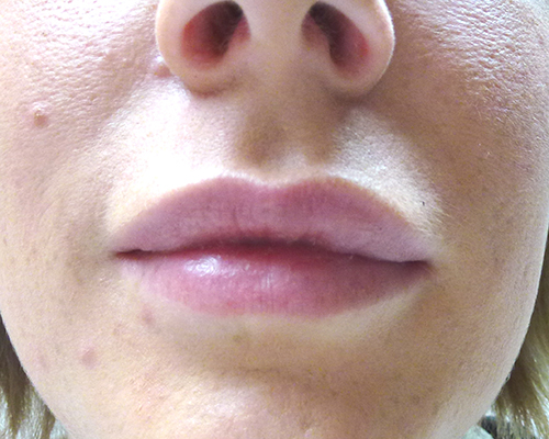 Nach Lippenaugmentation