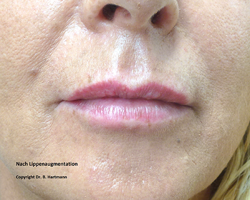 Nach Lippenaugmentation