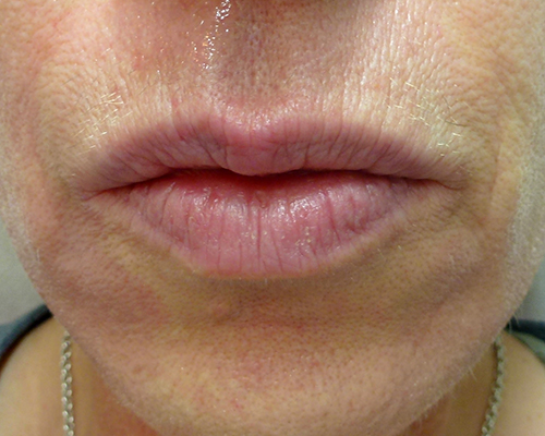 Vor Lippenaugmentation