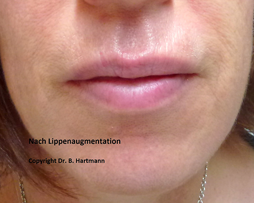 Nach Lippenaugmentation