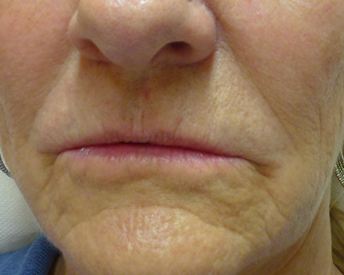 Vor Lippenaugmentation