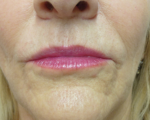 Nach Lippenaugmentation